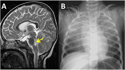 Catecholamine-Induced Secondary Takotsubo Syndrome in Children With Severe Enterovirus 71 Infection and Acute Heart Failure: A 20-year Experience of a Single Institute